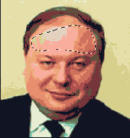 Удаление волос